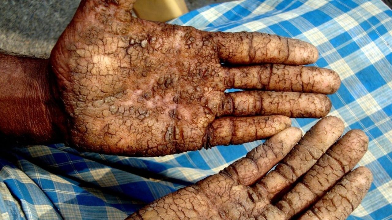 Bihar Arsenic Cancer